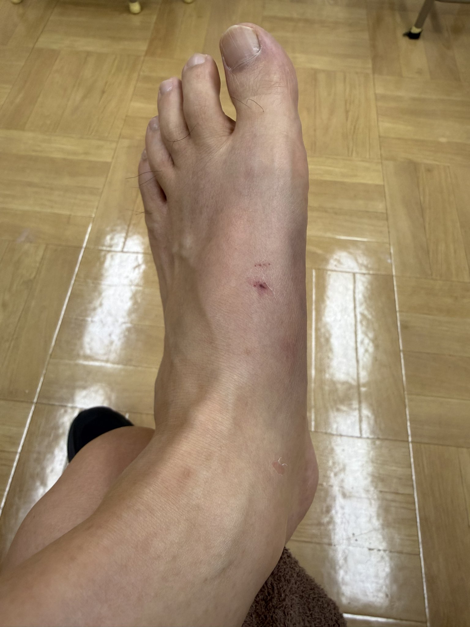 结城结弦公开的左脚训练受伤近况照片